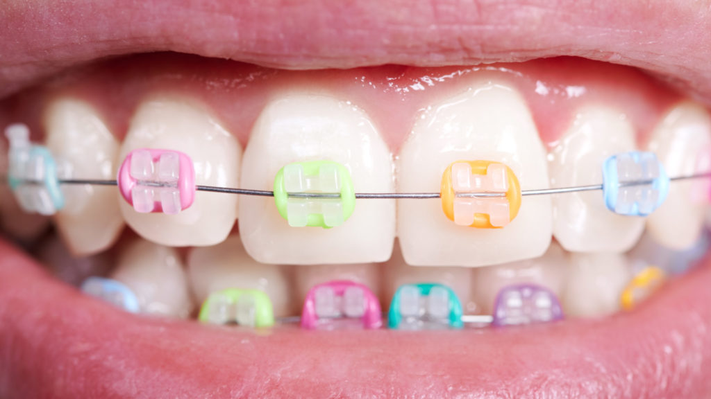 Los arcos dentales en Ortodoncia – Dental Direct